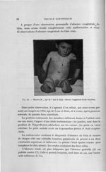Fig. 23. Maurice M..., âgé de 3 ans et demi. Absence congénitale totale des tibias - Titres et trava [...]