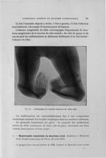 Fig. 24. Radiographie des membres inférieurs du même sujet - Titres et travaux scientifiques