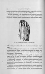 Fig. 25. Hypertrophie congénitale du deuxième orteil - Titres et travaux scientifiques