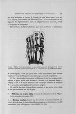 Fig. 26. Schéma d'après la radiographie du même pied montrant la dystrophie de la dernière phalange  [...]