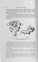 Fig. 41 et 42. Luxation en avant de l'atlas. Deuxième variété : par rupture du ligament transverse - [...]