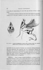 Fig. 45 et 46. Luxation par glissement en avant de l'atlas. Troisième variété, type unilatéral - Tit [...]
