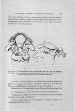 Fig. 47 et 48. A. Sub-luxation de l'atlas par hyper-flexion forcée de la tête. Vue postérieure. B. L [...]
