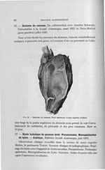 Fig. 50. Sarcome du sternum. Pièce opératoire. Coupe sagittale médiane - Titres et travaux scientifi [...]