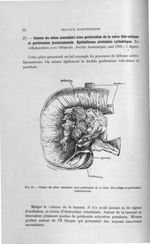 Fig. 56. Cancer du côlon ascendant avec perforation de la valve iléo-colique et perforation juxtatum [...]