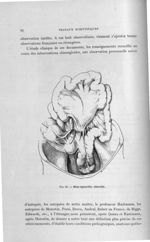 Fig. 58. Méso-sigmoïdite rétractile - Titres et travaux scientifiques