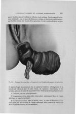 Fig. 63. Prolapsus du rectum (type coli invaginati) avec étranglement, gangrène et perforation - Tit [...]