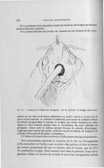 Fig. 64. Prolapsus du rectum (coli invaginati) - Titres et travaux scientifiques