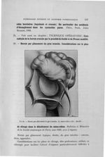 Fig. 66. Hernie par glissement du gros intestin - Titres et travaux scientifiques