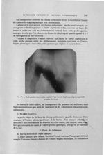 Fig. 67. Radiographie dans le plan sagittal d'une hernie diaphragmatique congénitale (estomac et côl [...]