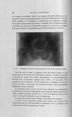 Fig. 72. Radiographie montrant les lésions d'ostéite du pubis - Titres et travaux scientifiques