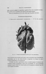 Fig. 73. Prostate de 320 grammes enlevée par la voie transvésicale - Titres et travaux scientifiques