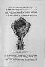 Fig. 74. Aspect de la cavité d'énucléation immédiatement après une prostatectomie transvésicale fait [...]