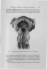 Fig. 77. Résultat d'une prostatectomie périnéale ancienne (4 ans) - Titres et travaux scientifiques