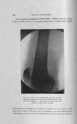 Fig. 82. Derv..., Pierre. Radiographie de profil, bien axée, montrant le projectile se projetant sur [...]