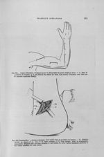 Fig. 103. Lignes d'incision classiques pour la découverte du nerf radial au bras / Fig. 104 (Personn [...]