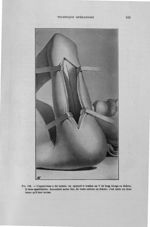 Fig. 106. L'aponévrose a été incisée ; on aperçoit le tendon en V du long triceps en dedans, la lame [...]