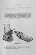Fig. 108. Etat du moignon et lambeaux donnés par l'opération-type de Ricard (avec lambeau dorsal) -  [...]