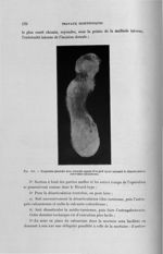 Fig. 111. Empreinte plantaire avec mauvais appuis d'un pied ayant nécessité la désarticulation inter [...]