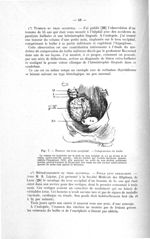 Fig. 7. Tumeur du trou occipital. - Compression du bulbe - Exposé des titres et des travaux scientif [...]