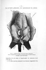 Fig. 2. Chienne mort-née, issue d'une chienne tuberculeuse - Exposé des titres et des travaux scient [...]