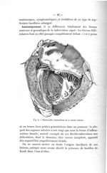 Fig. 6. Endocardite tuberculeuse de la valvule mitrale - Exposé des titres et des travaux scientifiq [...]