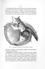 Fig. 7. Endocardite tuberculeuse des valvules mitrale et aortique - Exposé des titres et des travaux [...]