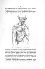 Fig. 8. Tumeur gazeuse sus- et sous-claviculaire - Exposé des titres et des travaux scientifiques. M [...]