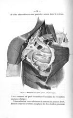 Fig. 9. Dissection de la poche gazeuse extra-thoracique - Exposé des titres et des travaux scientifi [...]
