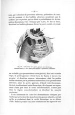 Fig. 10. Dissection de la poche gazeuse intra-thoracique - Exposé des titres et des travaux scientif [...]