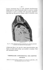 Fig. 11. Coupe schématique montrant la disposition de la perforation pulmonaire et pleurale et des e [...]