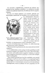 Fig. 12. Malformation congénitale du coeur chez un bébé hérédo-syphilitique - Exposé des titres et d [...]