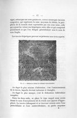 Fig. 3. Stéatose et début de sclérose intra-lobulaire - Titres et travaux scientifiques du Dr. René  [...]