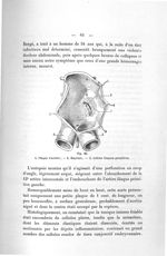 Fig. 26. 1, Plaque d'aortite ; - 2, Rupture ; - 3, Artères iliaques primitives - Titres et travaux s [...]