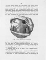 Fig. 27. Grossesse tubaire à terme, avec enfant mort - Titres et travaux scientifiques