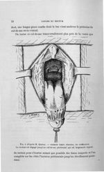 Fig. 1 (d'après M. Quénu). Premier temps périnéal de libération. Le rectum est dégagé jusqu'au cul-d [...]