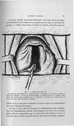Fig. 4. Temps abdominal (C). Le segment recto-sigmoïde a basculé dans le Douglas, on l'a tiré au deh [...]