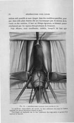Fig. 11. Hystérectomie vaginale pour cancer du col. Le cul-de-sac vasico-utérin est ouvert. La face  [...]