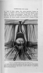 Fig. 12. Hystérectomie vaginale pour cancer du col. A mesure que le corps utérin se dégage, attiré p [...]