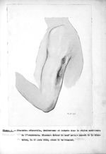 Figure I. Cicatrice rétractile, douloureuse et indurée dans la région antérieure de l'avant-bras. Bl [...]