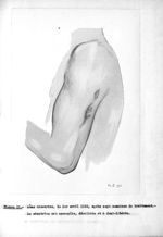 Figure II. Même cicatrice, le 1er avril 1916, après sept semaines de traitement - Addendum à l'expos [...]