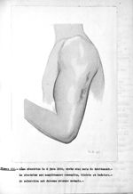 Figure III. Même cicatrice le 8 juin 1916, après cinq mois de traitement - Addendum à l'exposé des t [...]
