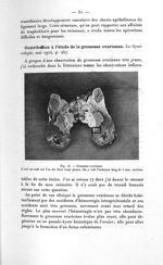 Fig. 13. Grossesse ovarienne - Titres et travaux scientifiques