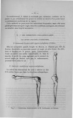 Fig. 3. Ostéotomie chantournante de M. Lardennois (de Reims) - Titres et travaux scientifiques