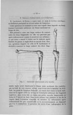 Fig. 4. Ostéotomie chantournante avec encoche - Titres et travaux scientifiques