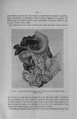 Fig. 14. Pancréatite hémorragique avec stéato-nécrose d'origine biliaire, chez le chien - Titres et  [...]