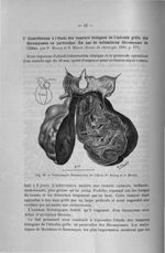 Fig. 19. Volumineux fibromyome de l'iléon (P. Brocq et S. Hertz) - Titres et travaux scientifiques