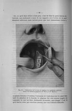 Fig. 21. Extraction de la dent de sagesse du maxillaire inférieur. Tracé du lambeau gingival. (P. Br [...]