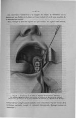 Fig. 22. Extraction de la dent de sagesse du maxillaire inférieur. Le lambeau gingival libéré est ré [...]