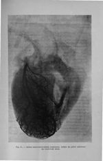 Fig. 25. Artère interventriculaire antérieure. Artère du pilier antérieur du ventricule droit - Titr [...]